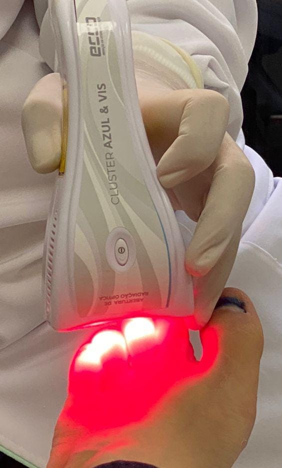 tratamento de podologia com laser para feridas nos pés em curitiba